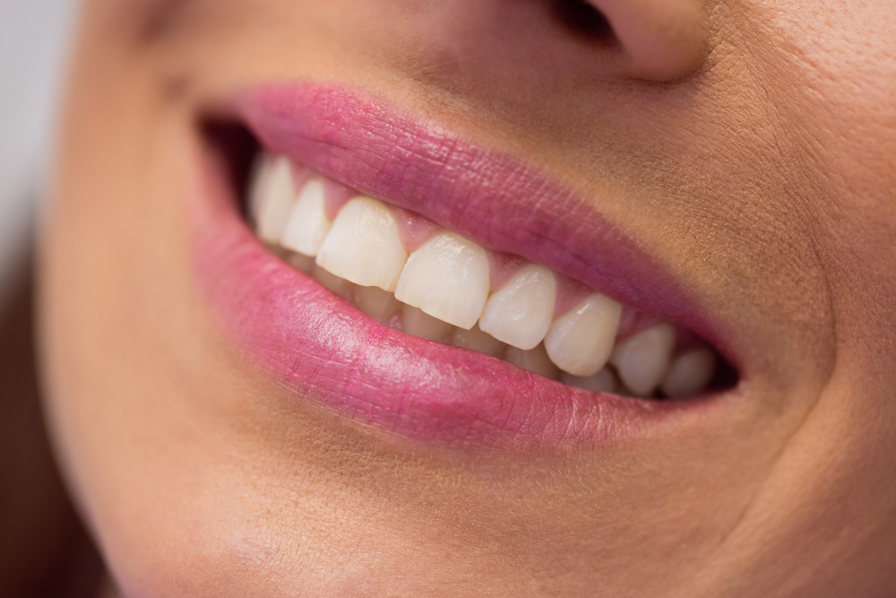 Cuidado com o clareamento dental caseiro: ele pode destruir o esmalte do seu dente