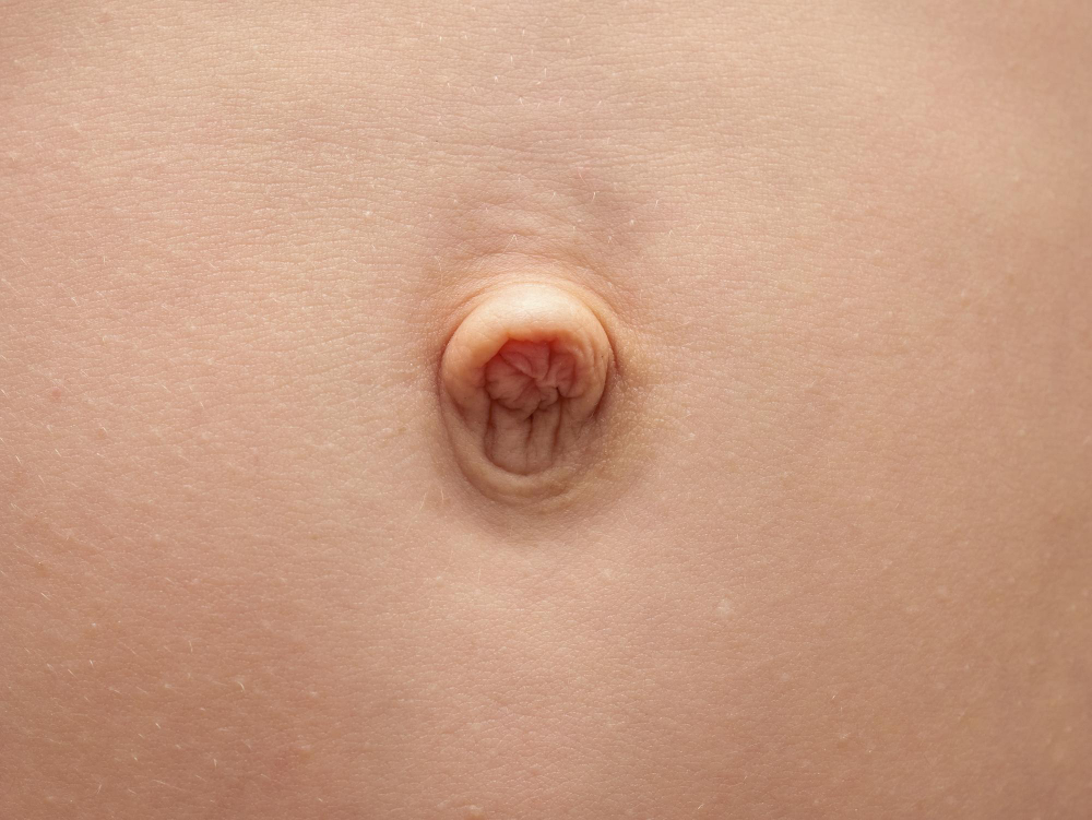 Hérnia Umbilical: Quando o “carocinho” no umbigo merece atenção médica