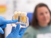 Implante dentário dura para sempre? Sete mitos e verdades que você precisa saber