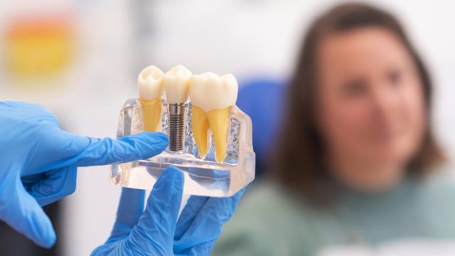 Implante dentário dura para sempre? Sete mitos e verdades que você precisa saber