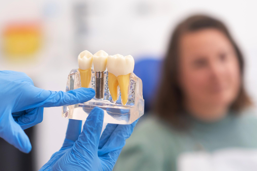Implante dentário dura para sempre? Sete mitos e verdades que você precisa saber