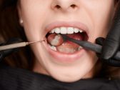 Clareamento dental com receitas caseiras pode danificar os dentes, diz especialista